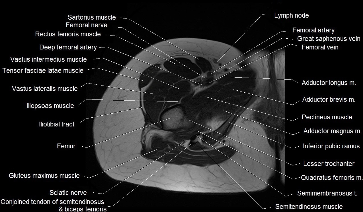 MRI thigh cross sectional anatomy image 14.webp